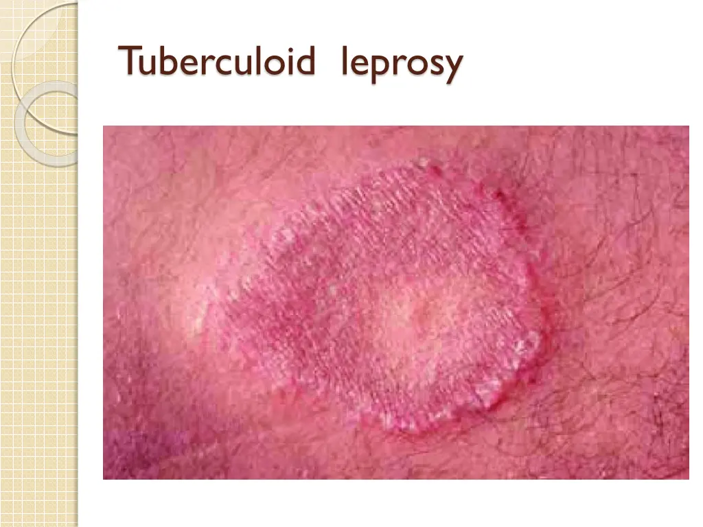 tuberculoid leprosy
