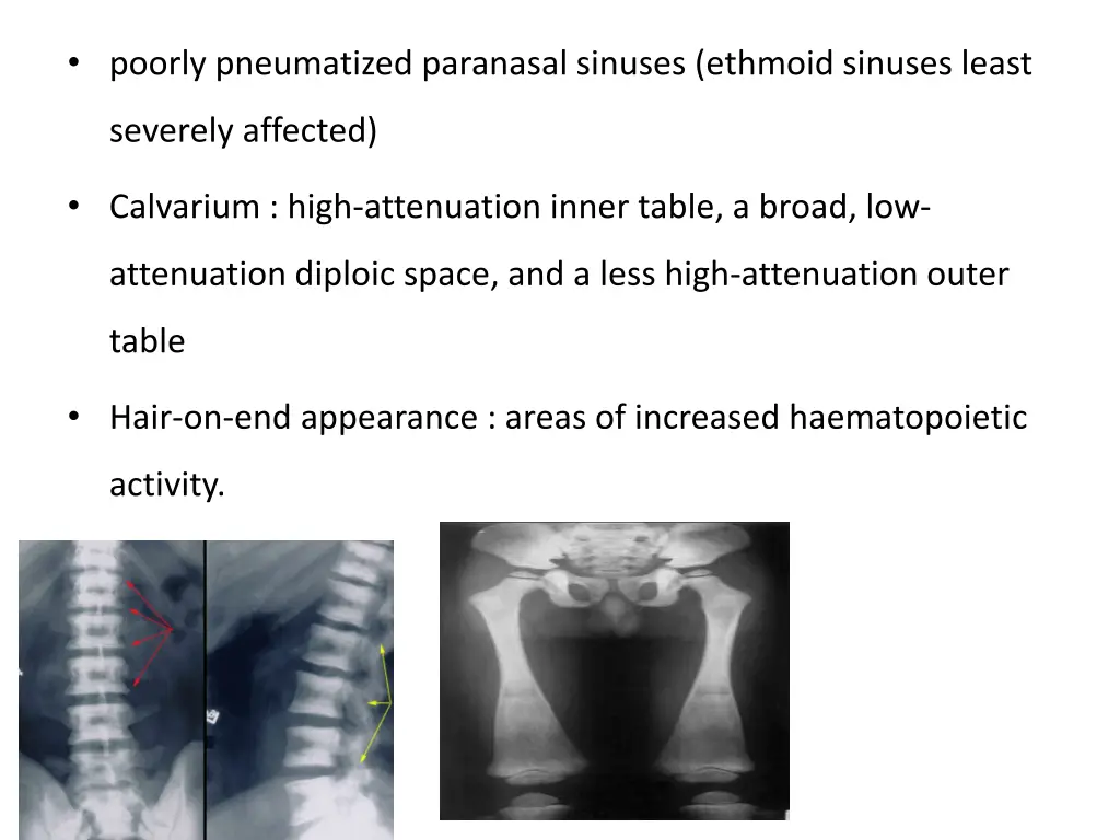 poorly pneumatized paranasal sinuses ethmoid
