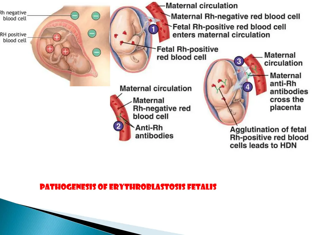 pathogenesis of erythroblastosis fetalis