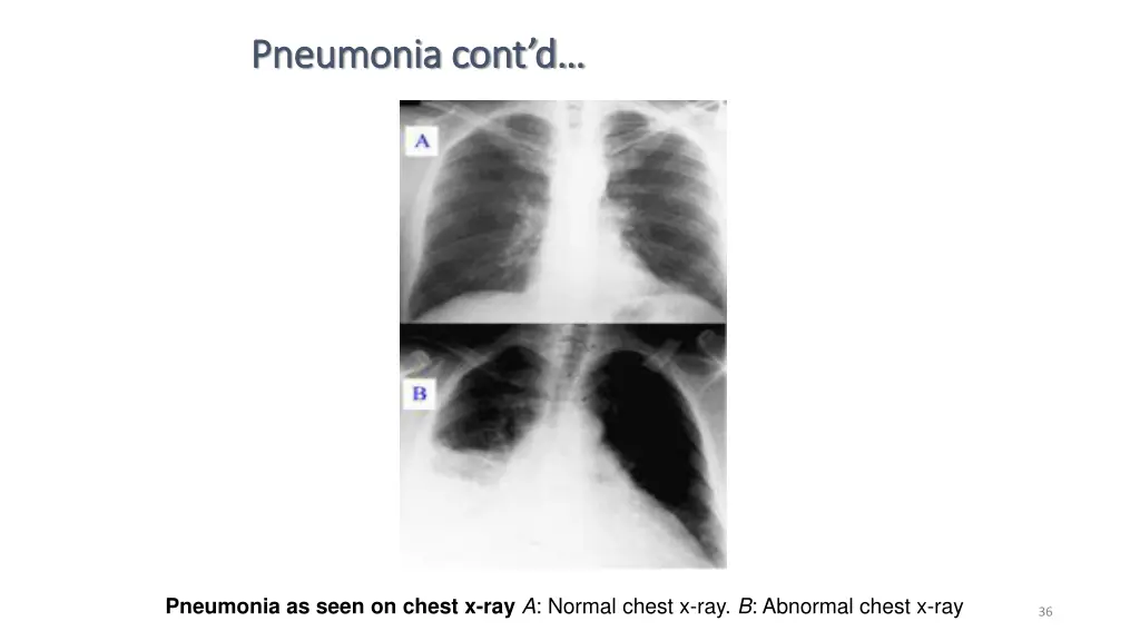 pneumonia cont d pneumonia cont d 28