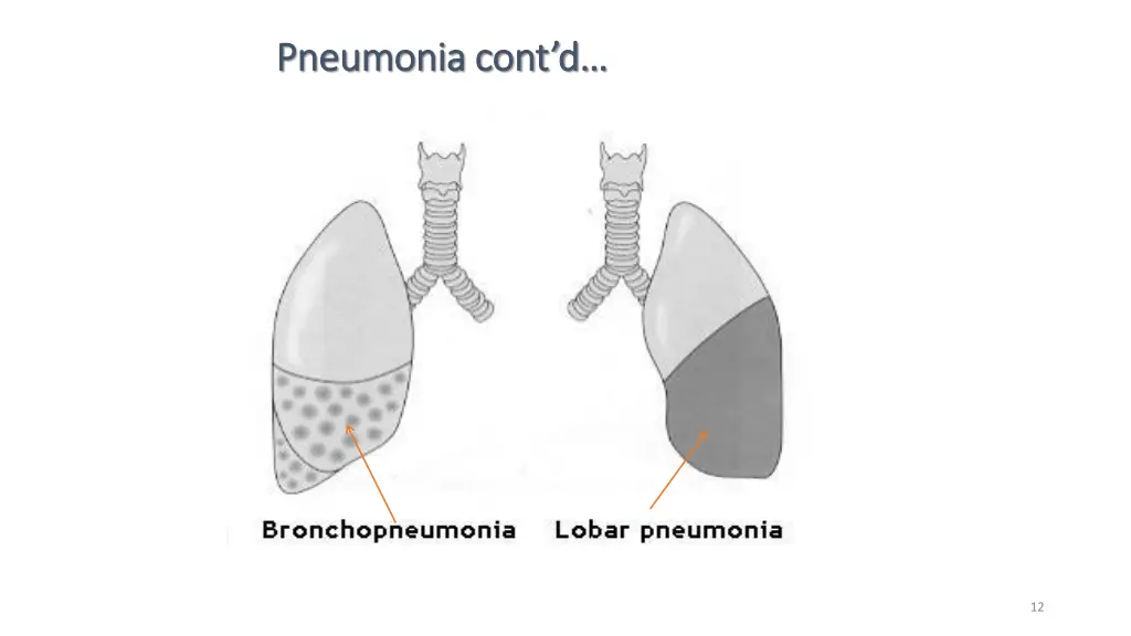 pneumonia cont d pneumonia cont d 6