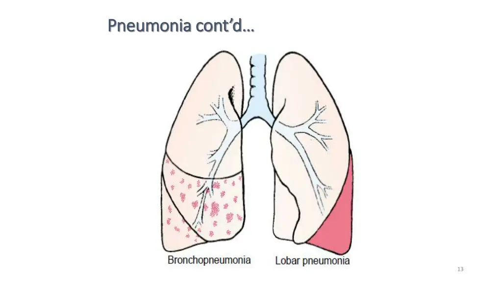 pneumonia cont d pneumonia cont d 7