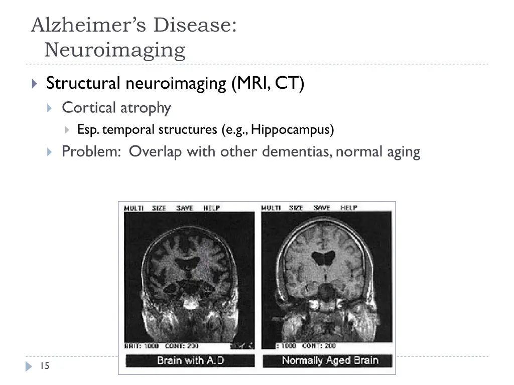 alzheimer s disease neuroimaging