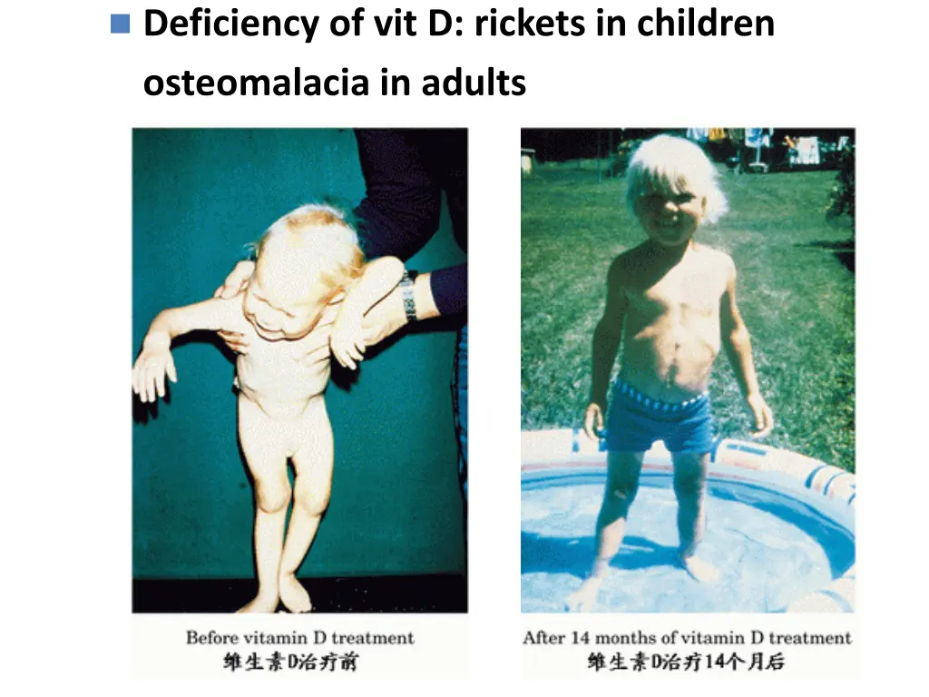 deficiency of vit d rickets in children