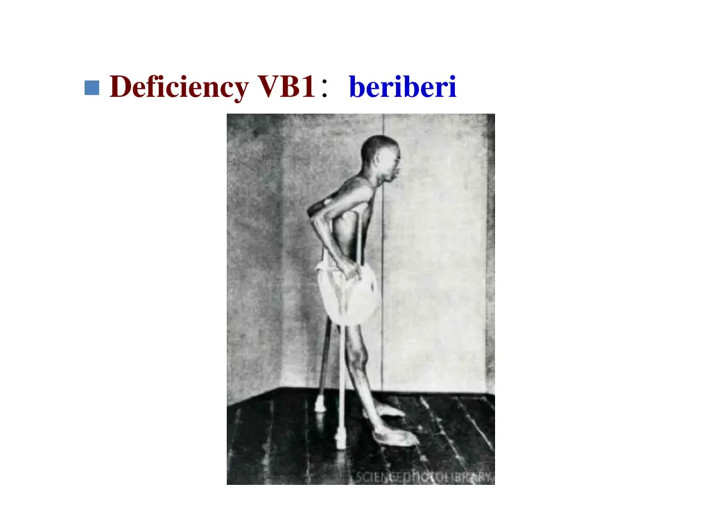 deficiency vb1 beriberi