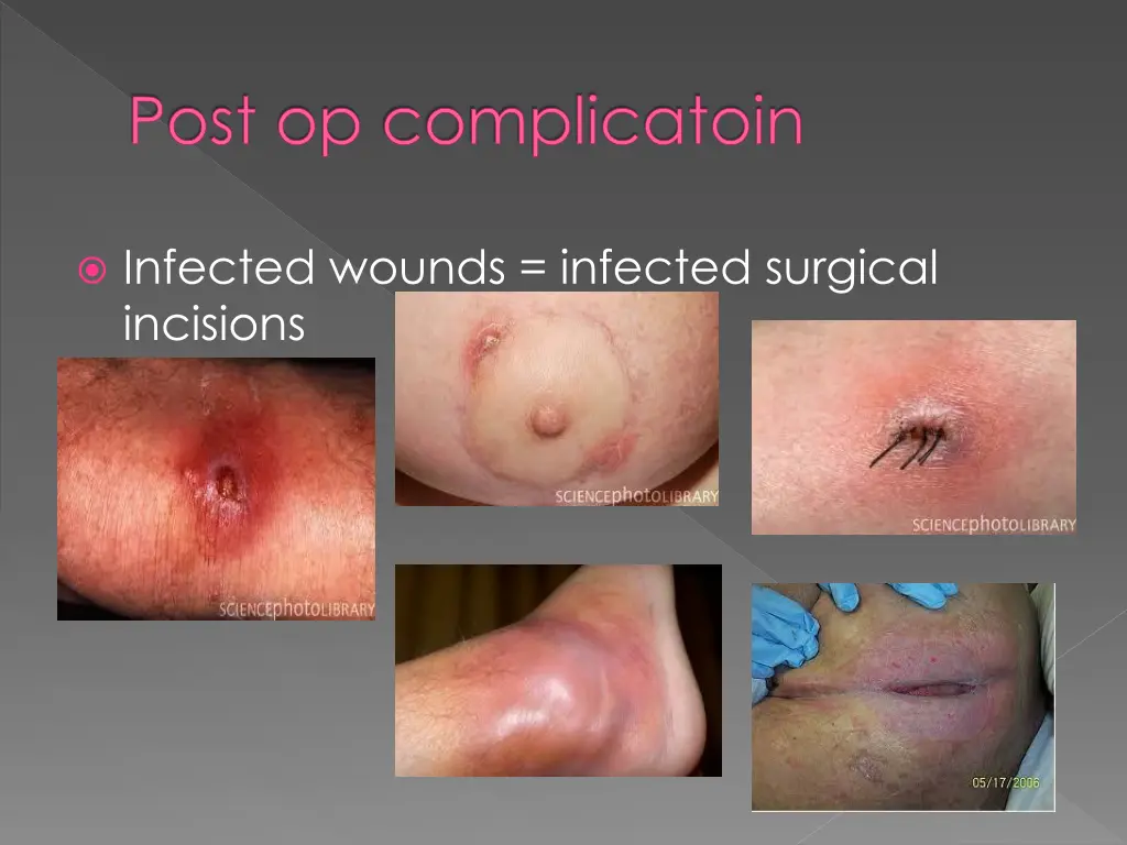 post op complicatoin