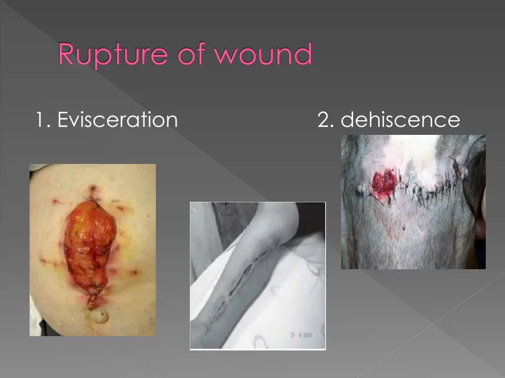 rupture of wound