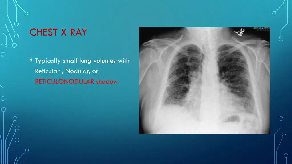 chest x ray