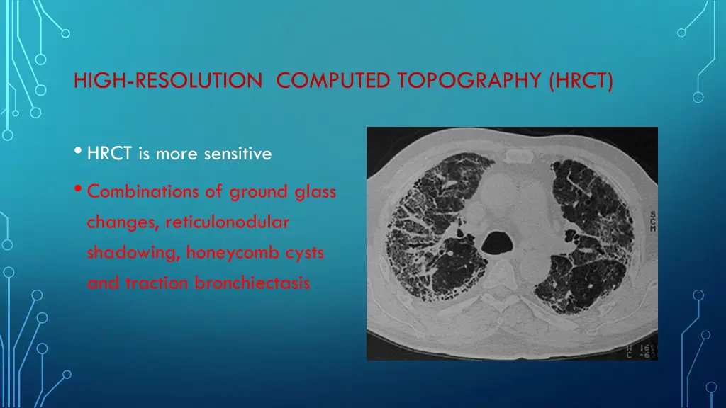 high resolution computed topography hrct