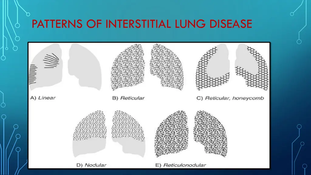 patterns of interstitial lung disease
