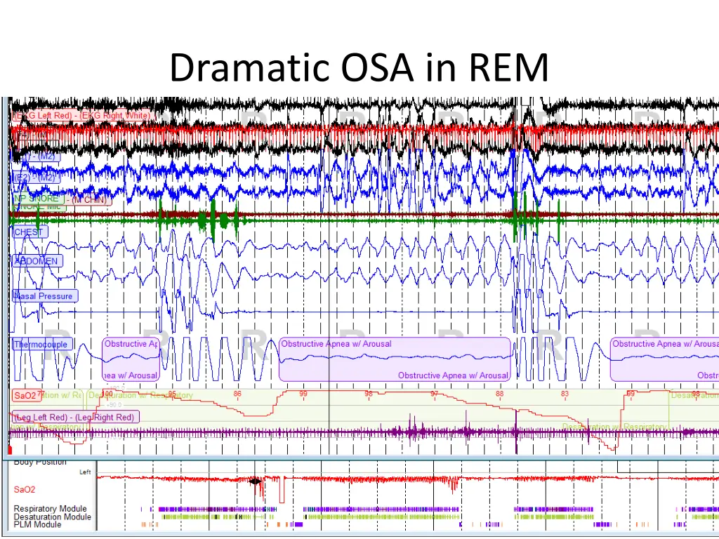 dramatic osa in rem