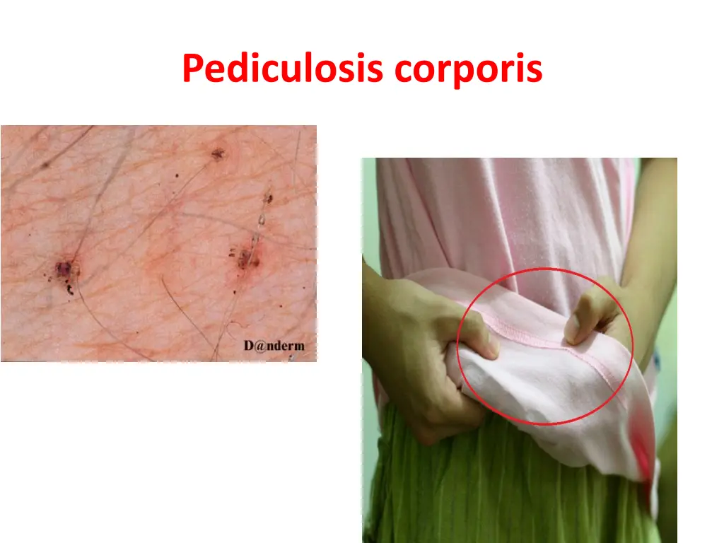 pediculosis corporis 1