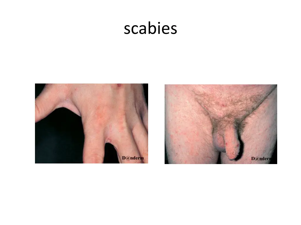 scabies 2
