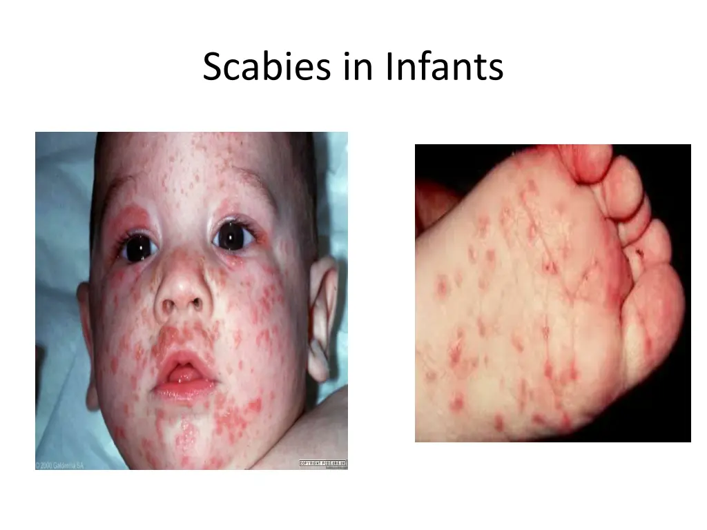 scabies in infants