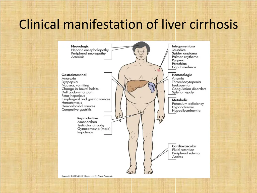 clinical manifestation of liver cirrhosis