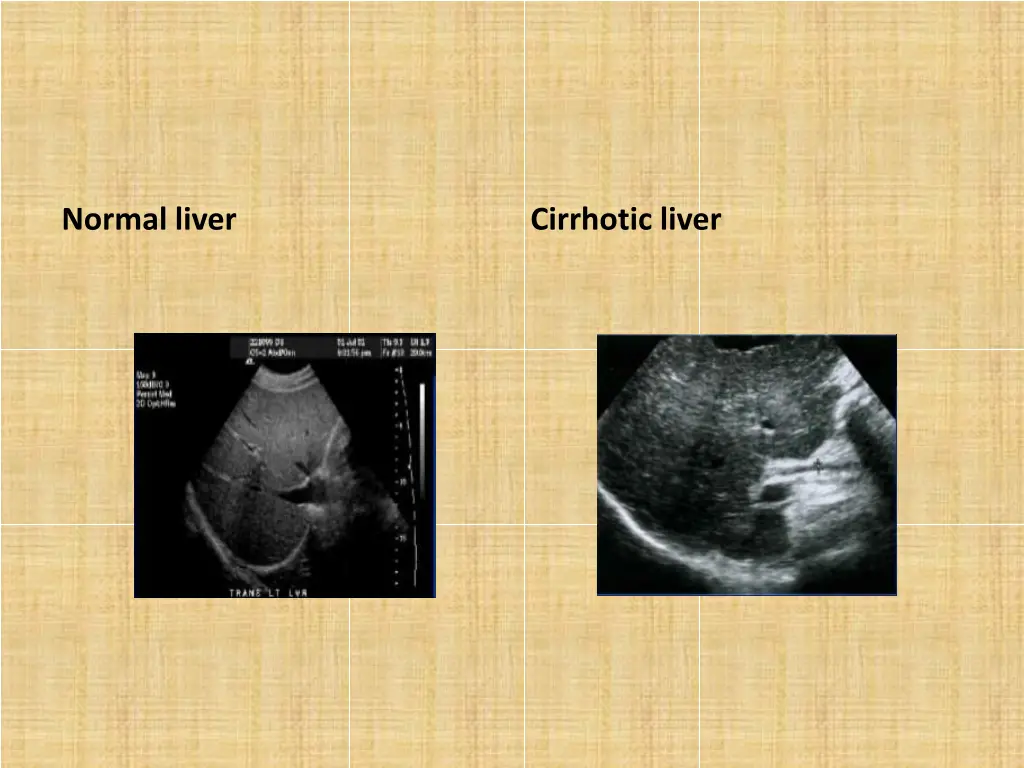normal liver