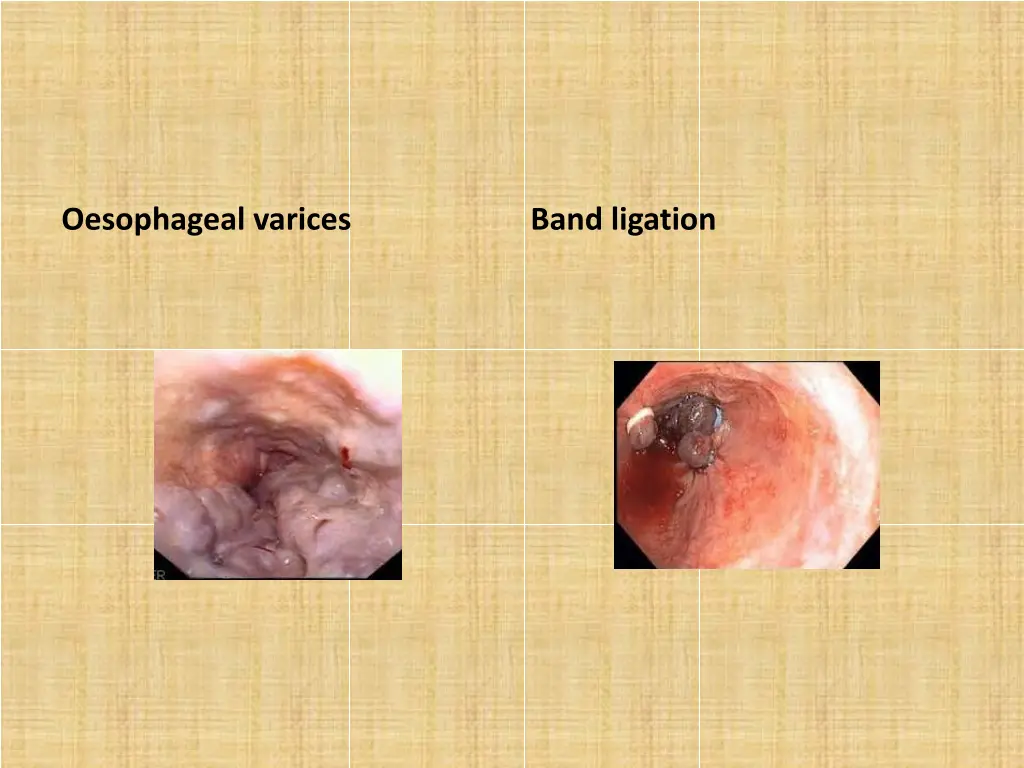 oesophageal varices 1