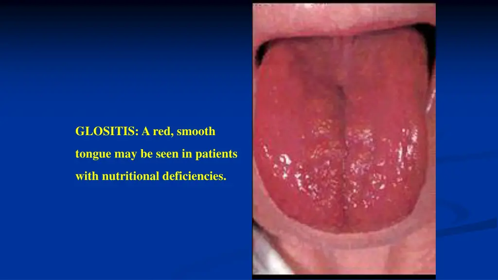 glositis a red smooth