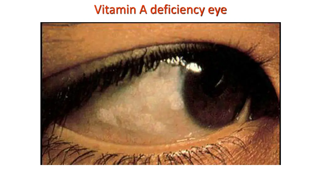 vitamin a deficiency eye
