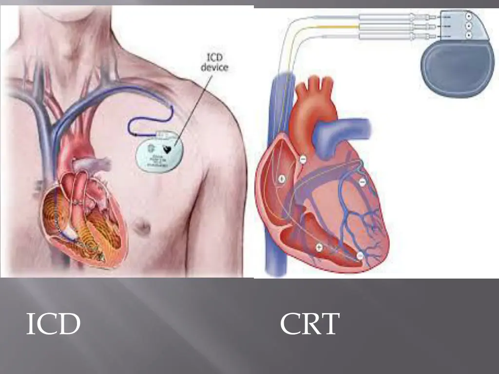 icd crt