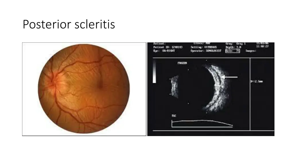 posterior scleritis