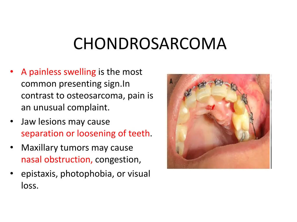 chondrosarcoma 2