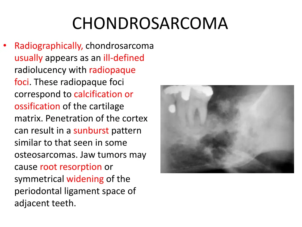 chondrosarcoma 3