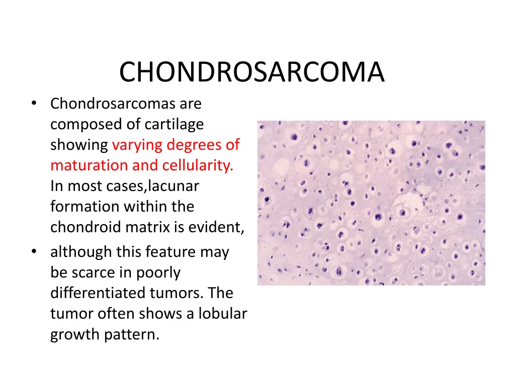 chondrosarcoma chondrosarcomas are composed