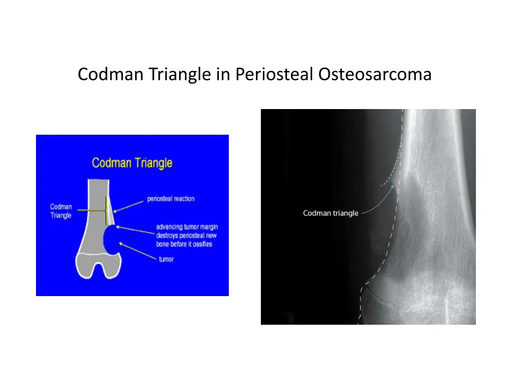 codman triangle in periosteal osteosarcoma