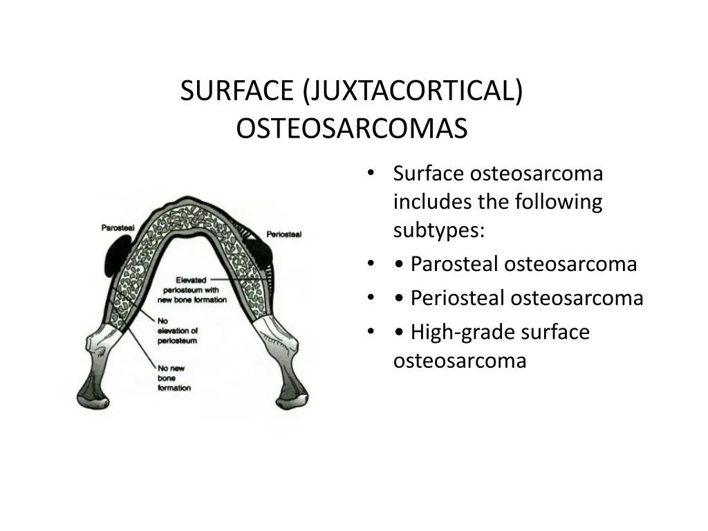 surface juxtacortical osteosarcomas 1