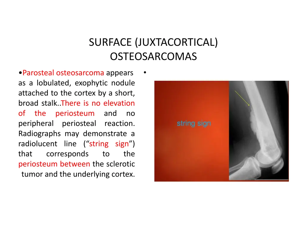 surface juxtacortical osteosarcomas 2
