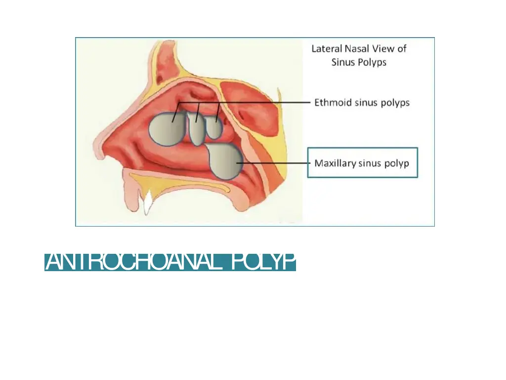 antrochoanal polyp