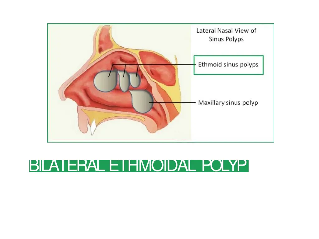bilateral ethmoidal polyp
