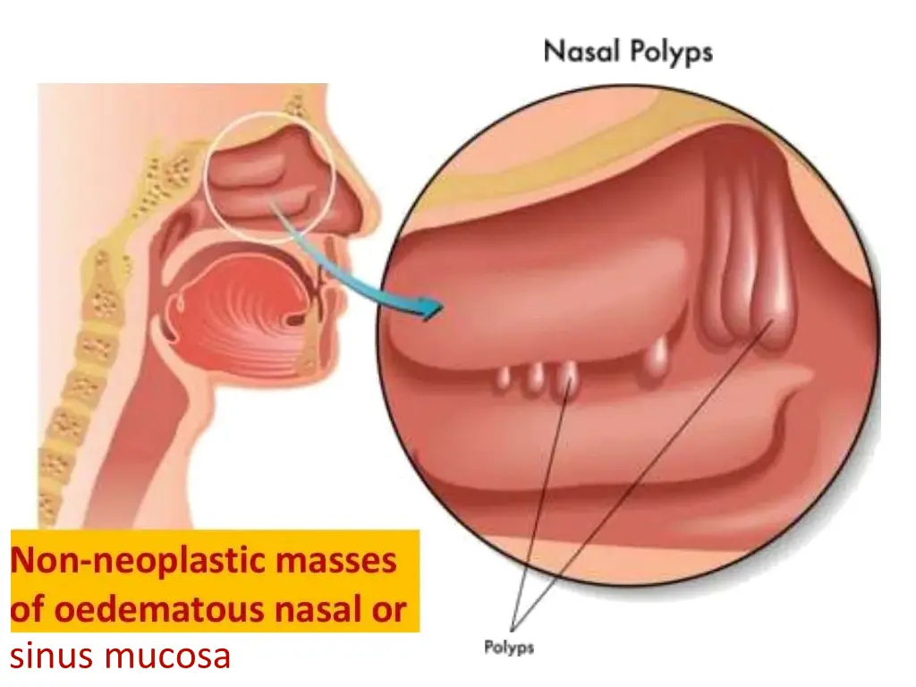 sinus mucosa