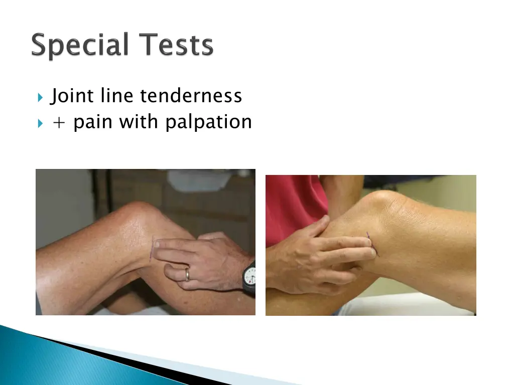 joint line tenderness pain with palpation