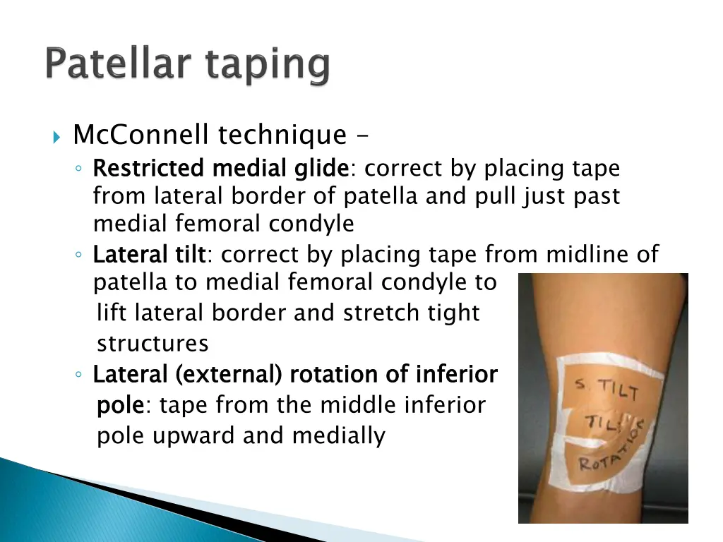 mcconnell technique restricted medial glide from