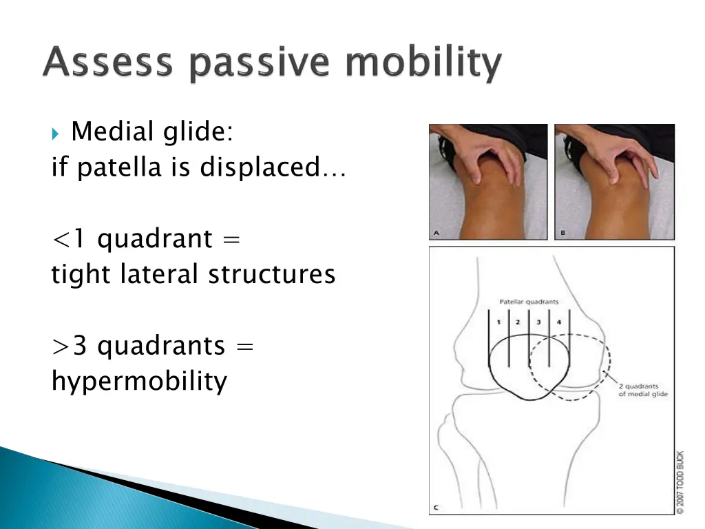 medial glide if patella is displaced