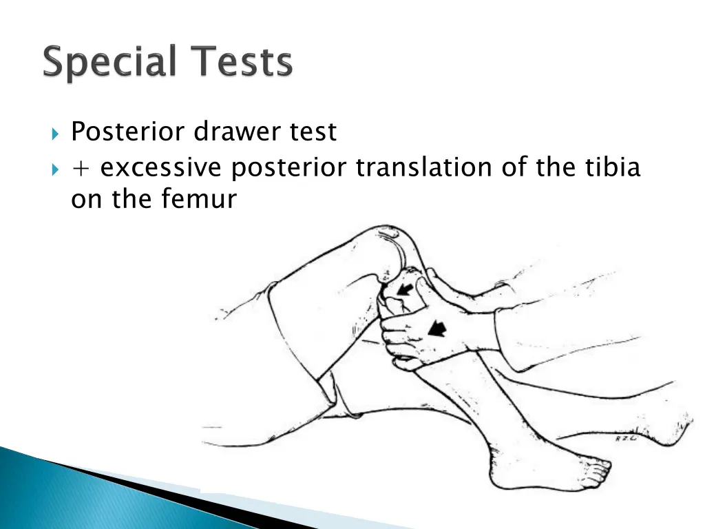 posterior drawer test excessive posterior