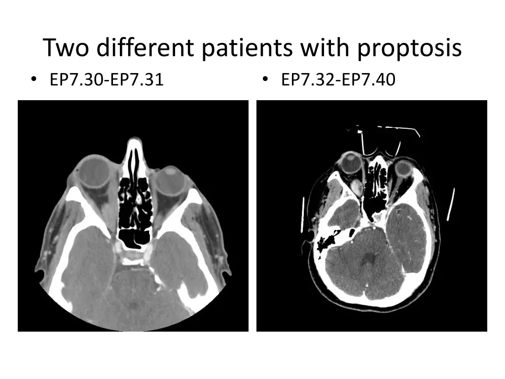 two different patients with proptosis
