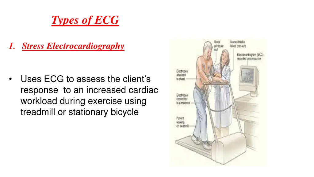 types of ecg