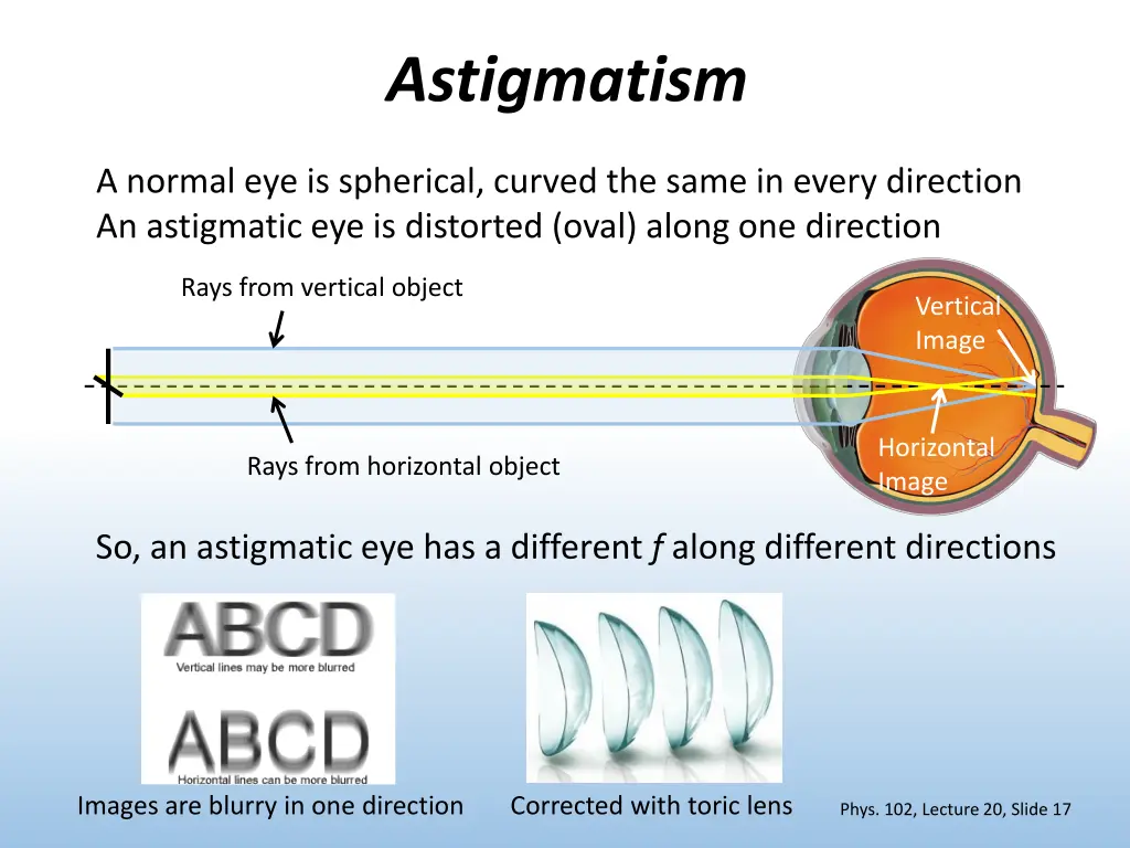 astigmatism