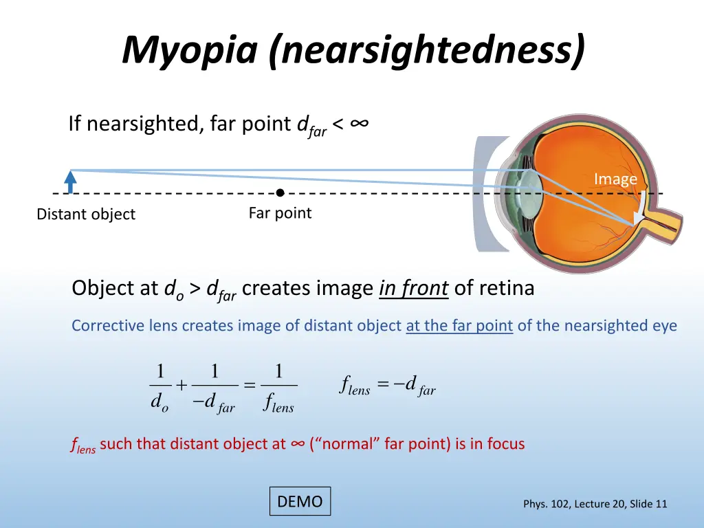 myopia nearsightedness