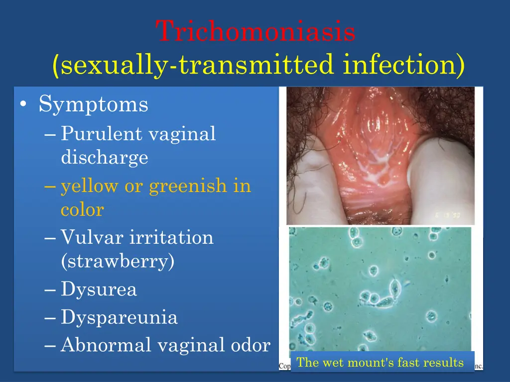 trichomoniasis