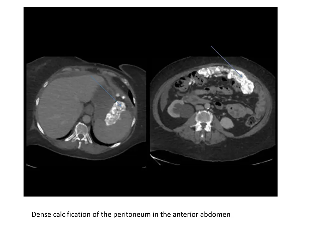 dense calcification of the peritoneum