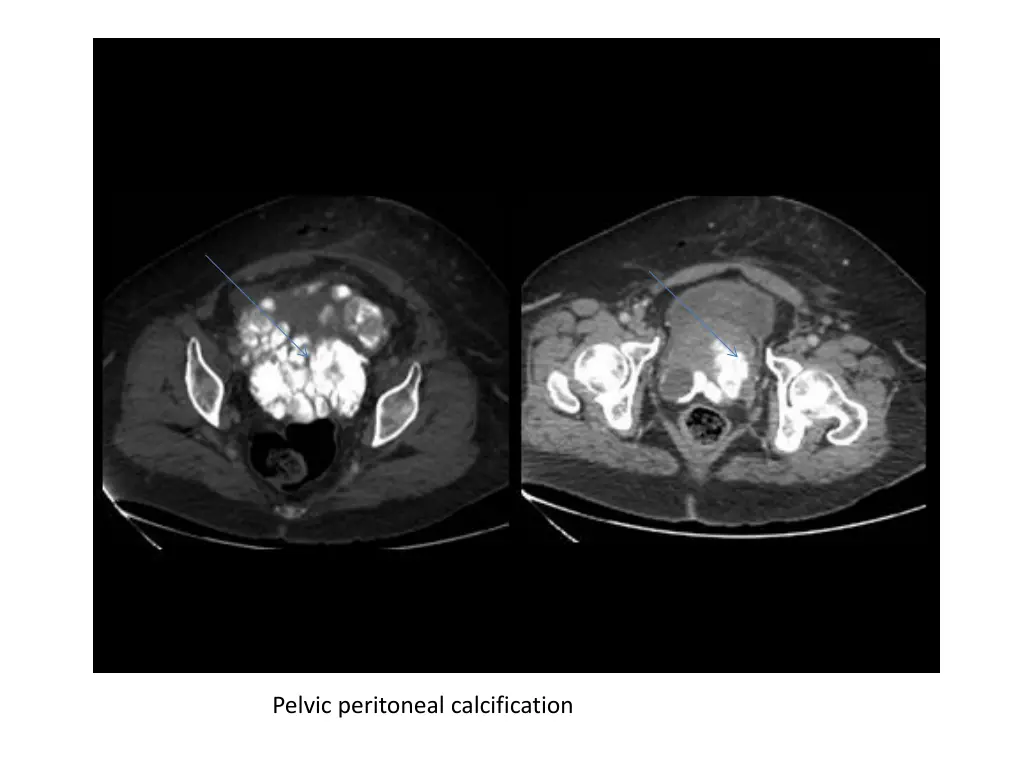 pelvic peritoneal calcification