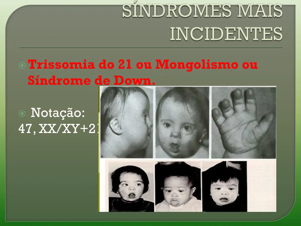 trissomia do 21 ou mongolismo ou s ndrome de down