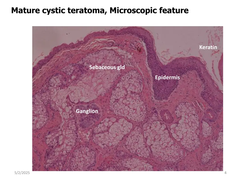 mature cystic teratoma microscopic feature