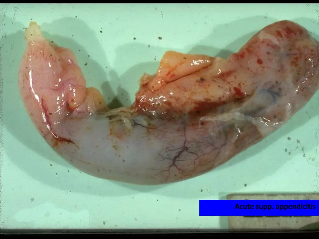 acute supp appendicitis