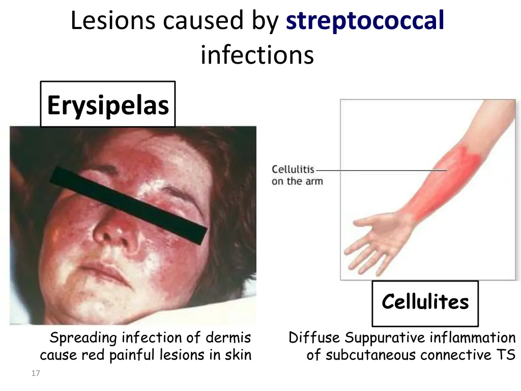 lesions caused by streptococcal infections