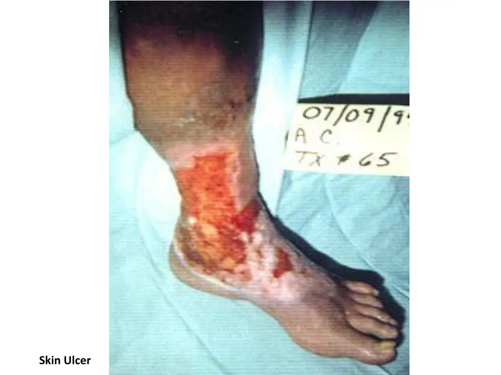 skin ulcer